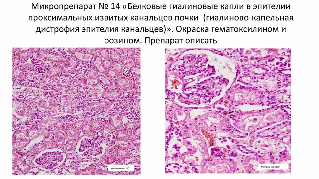 Гидропическая дистрофия эпителия канальцев почки. Гиалиново-капельная дистрофия эпителия канальцев почки. Гиалиново капельная дистрофия микропрепарат. Гиалиново-капельная дистрофия почек микропрепарат. Белковые канальцы