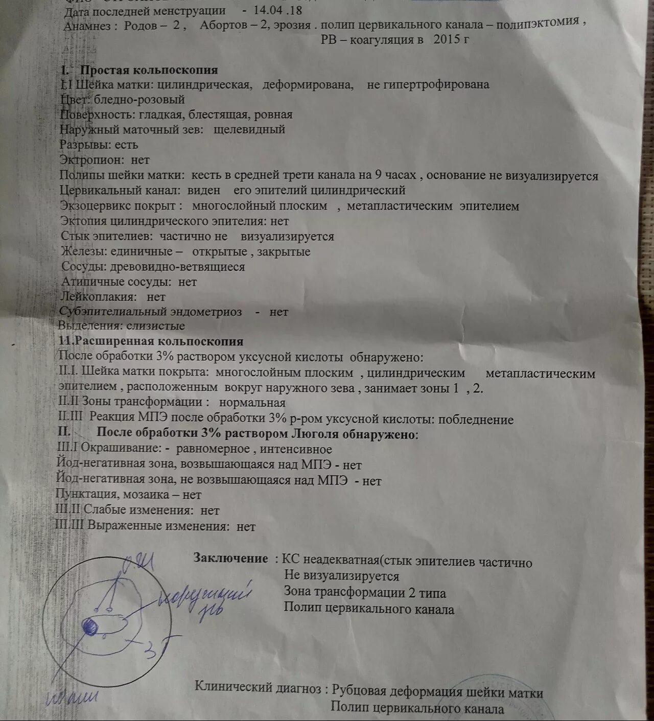 Шейку матки под микроскопом как называется процедура. Заключение кольпоскопии шейки матки. кольпоскопия нормальное заключение. заключения кольпоскопии и диагнозы. протоколы кольпоскопии заключения.