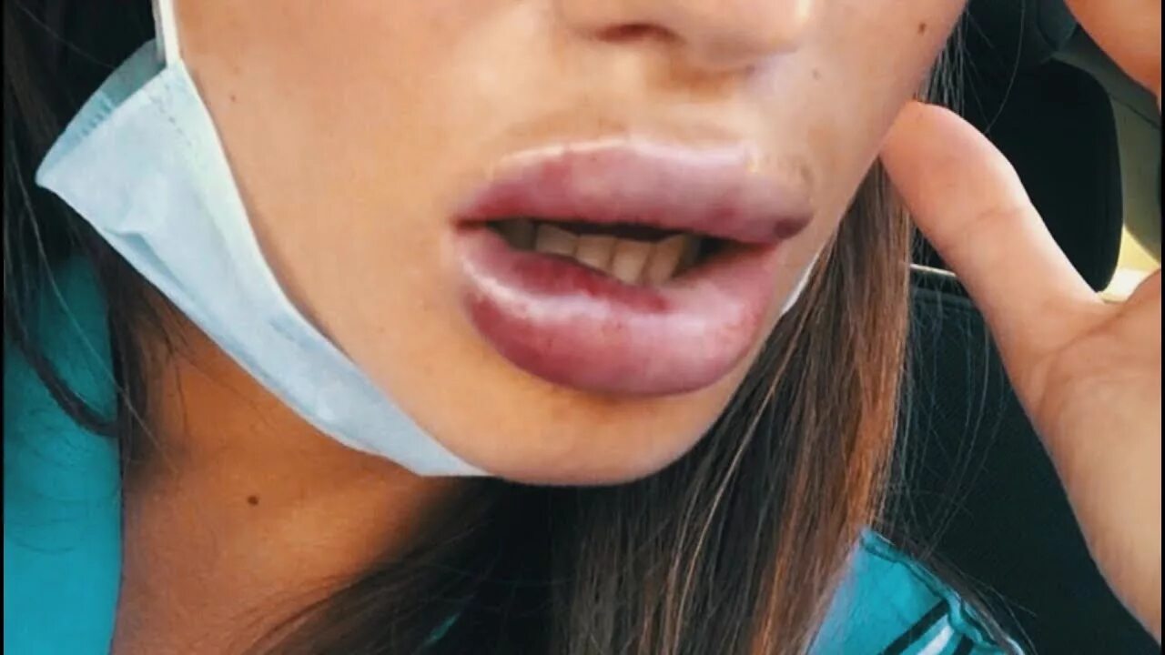 Губы тп брауде. Губы тп брауде