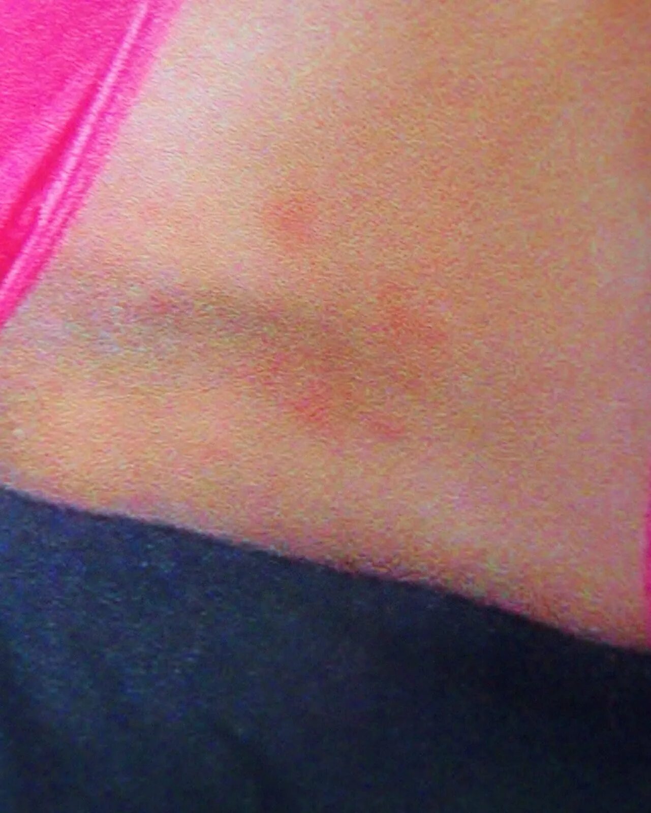 Polymorphous Light Eruption (PMLE) Pictures and Sun Allergy Rash Images