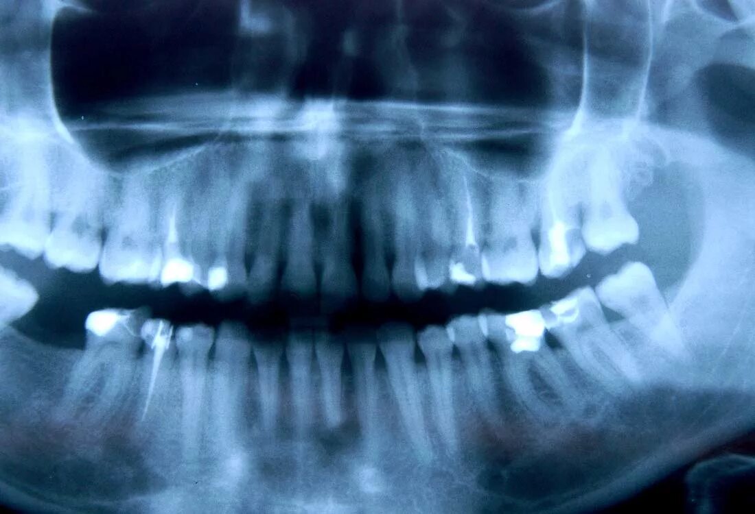 Снимок зубов видное. Перелом челюсти рентген. Перелом челюсти рентгеновский снимок. Перелом нижней челюсти рентген. Рентген верхней челюсти.