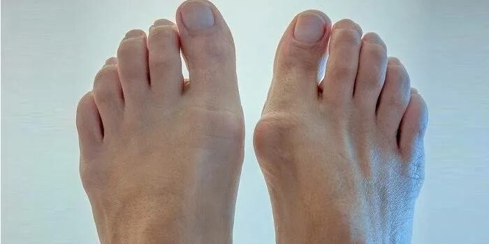 Ревматоидный артрит стопы. Бурсит 1 плюснефалангового сустава. Артрит суставов пальцев стопы. Острый артрит плюснефалангового сустава. Подагрический артрит рентген стопы.