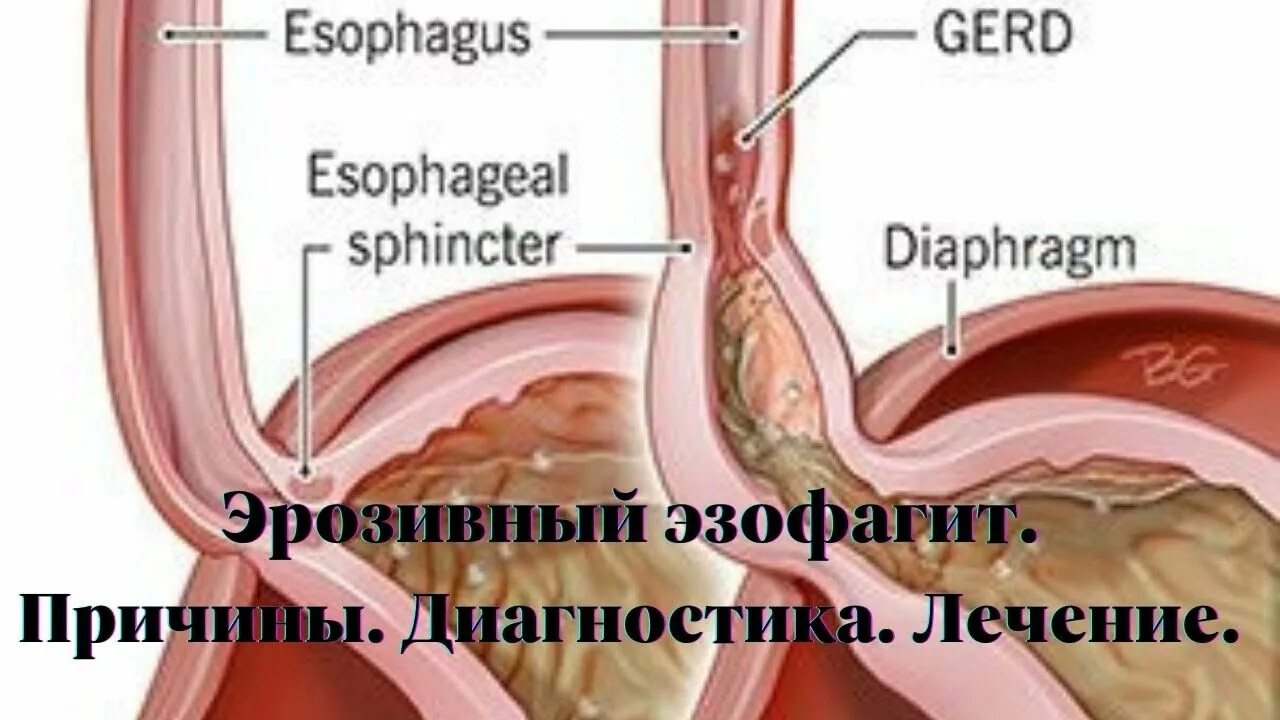 Лечение эрозивного пищевода. Эрозивный рефлюкс-эзофагит. Эрозия пищевода эзофагит.