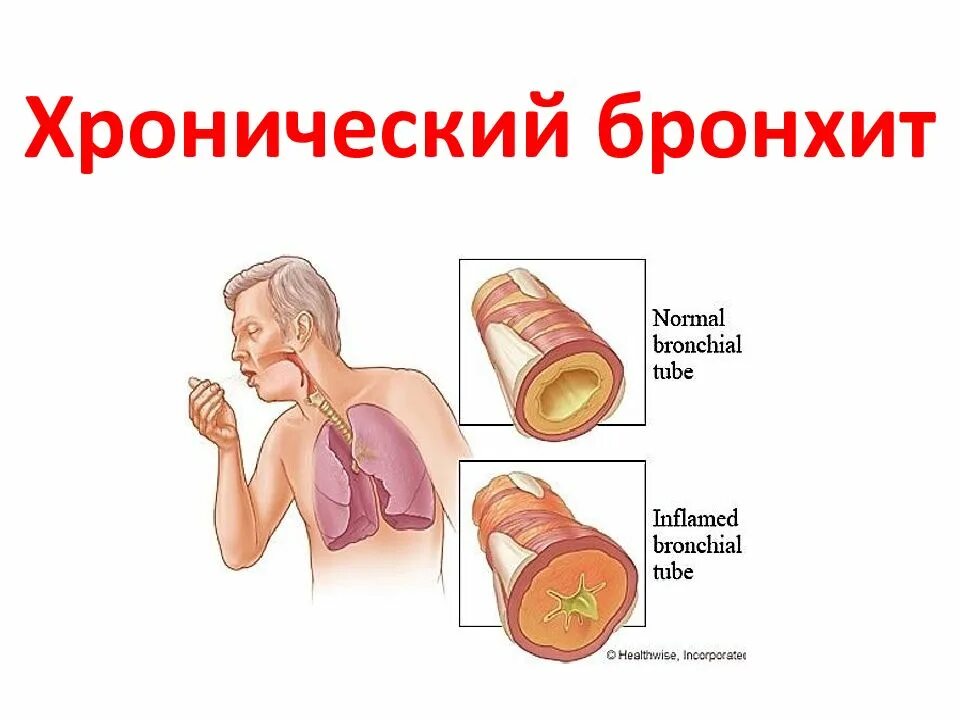 Хроническое воспаление бронхов. Острое воспаление слизистой оболочки бронхов. Сухой кашель при хроническом бронхите. Хронический бронхит болезнь. Воспаление хронического бронхита.