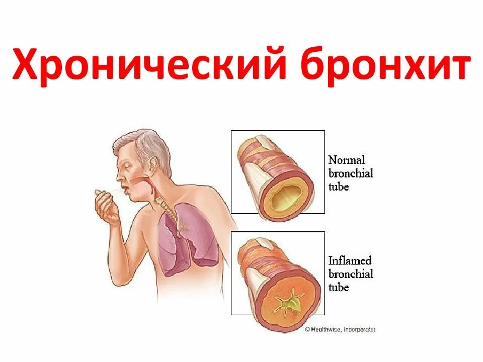 Б бронхит. Острый и хронический бронхит. Бронхит хронический хронический.