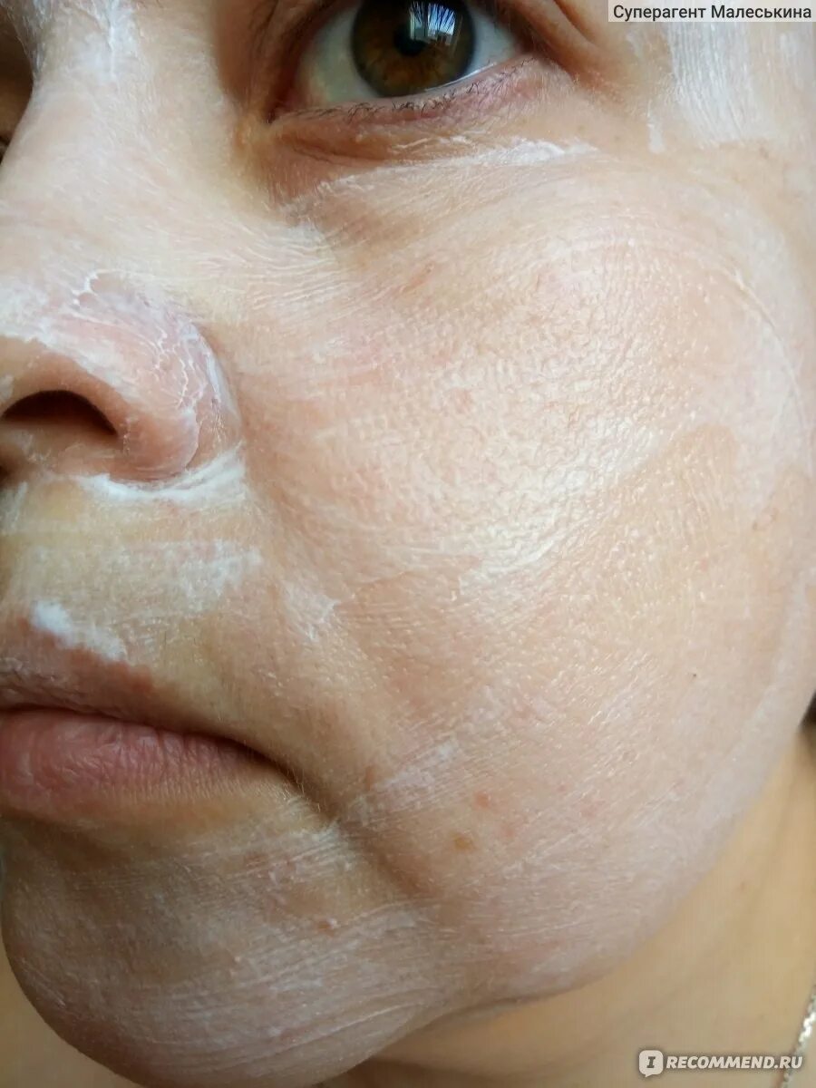 Пигментация после пилинга. Алмазная дермабразия (пилинг). Наноперфорация рубцов. Лентиго, хлоазма, веснушки. Пигментация после пилинга.