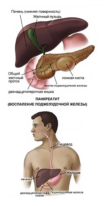 Хронический панкреатит симптомы у мужчин. Симптомы панкреатита поджелудочной железы. заболевания поджелудочной железы симптомы и признаки. лечение поджелудочной железы у мужчин. поджелудочной железы симптомы проявление болезни.