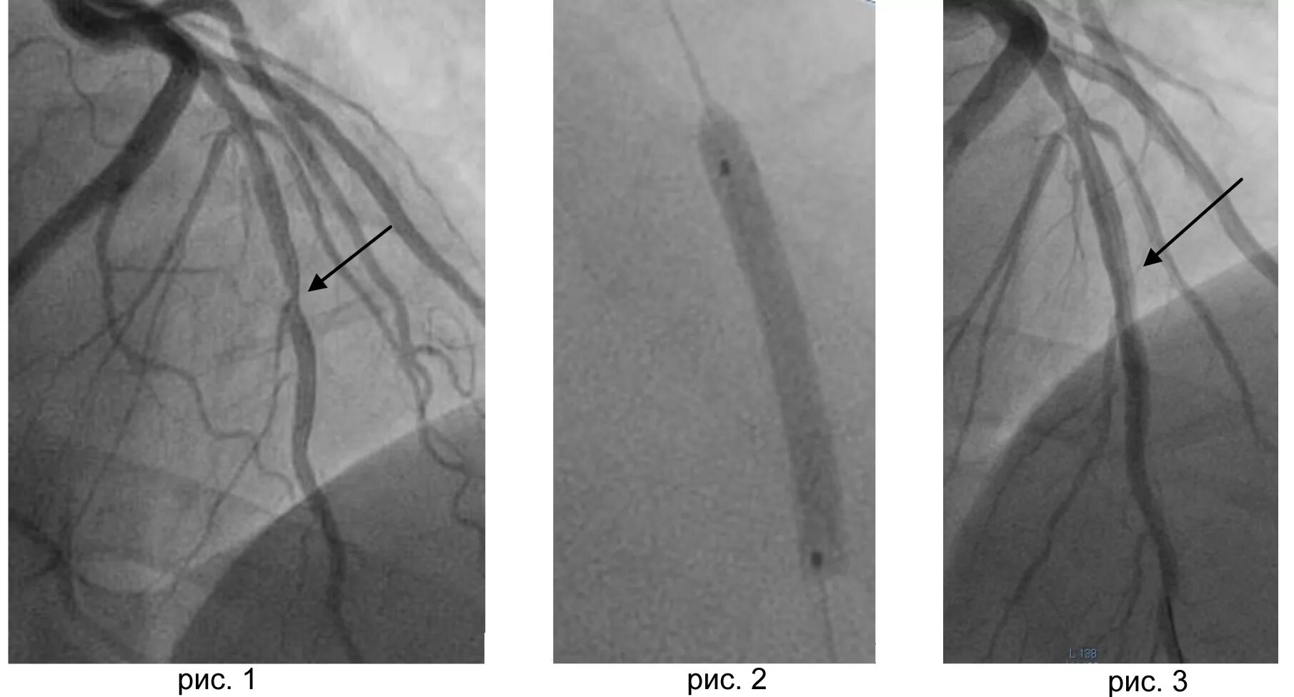 Коронарография стентирование. Коронарография сосудов стентирование. Коронароангиография стентирование. Коронарные артерии коронароангиография. Стентирование сосудов последствия