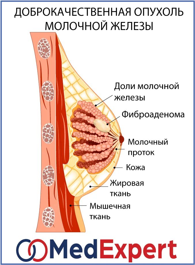 Формы уплотнений в молочной железе. Опухоль в молочной железе. доброкачественная опухоль груди. доброкачественная опухоль грудной железы. новообразование в грудной железе.