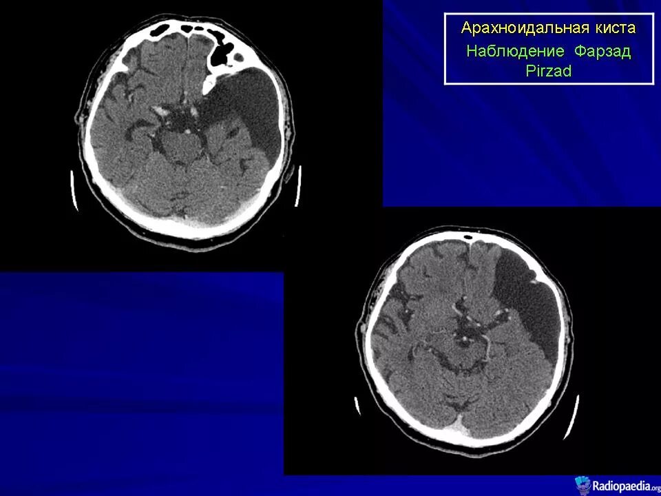Ретроцеребральная киста кт. Арахноидальная киста левой височной доли мрт. Арахноидальная киста лобной области.