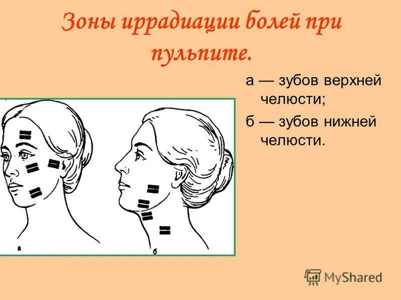 Иррадиация боли в нижнюю челюсть. Зоны иррадиации боли при пульпите. Зоны иррадиации боли при пульпите по и.г Лукомскому. Иррадиация боли при пульпите зубов нижней челюсти. Иррадиация боли при пульпите верхней челюсти.