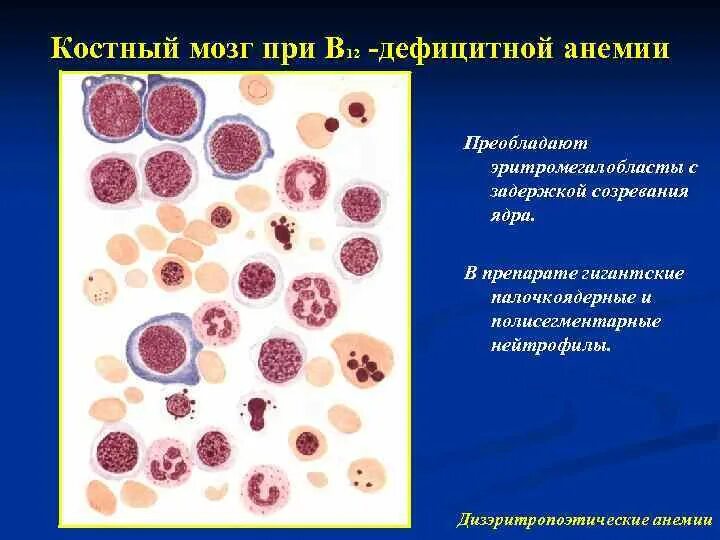 Дизэритропоэтические анемии. Полисегментарные ядра нейтрофилов. Дизэритропоэтической анемии препарат. Гемолитическаяанемия картина кр.