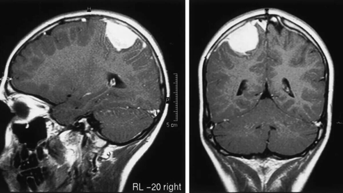После операции менингиомы головного мозга. Менингиома лобной доли мрт. Менингиомы головного мозга на кт. Менингиома лобной доли кт.