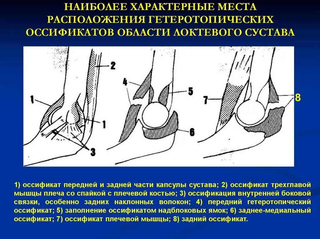 Какой врач лечит локтевые суставы. Оссификат локтевого сустава. Гетеротопическая оссификация локтевого сустава рентген. Окостенение локтевого сустава. Оссификаты коленного сустава.