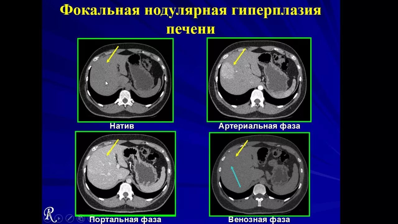 Кт после химиотерапии. Узловая гиперплазия печени кт. Фокальная нодулярная гиперплазия печени на кт. Фокальная нодулярная гиперплазия мрт.