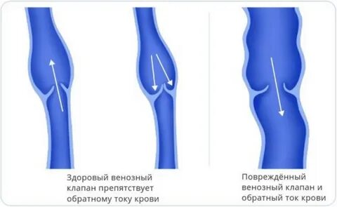 Венозные клапаны