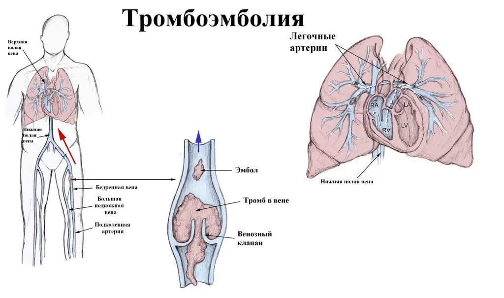 Тромбоэмболия тэла. Тромбоэмболия ветвей легочной артерии. Тромбоэмболия легочной артерии (Тэла). Тромб легочной артерии тромбоэмболия. Эмболия тромбом легочной артерии.