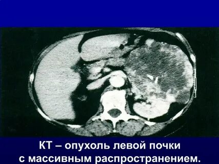 Солидное образование левой почки