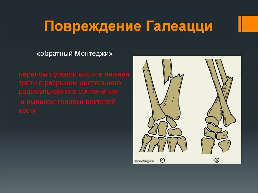 Разрыв кости. Переломовывих Монтеджи. Перелом Монтеджи и Галеацци. Переломо-вывихи Монтеджи. Механизм перелома вывиха Галеацци.