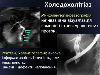 Холедохолитиаз рекомендации