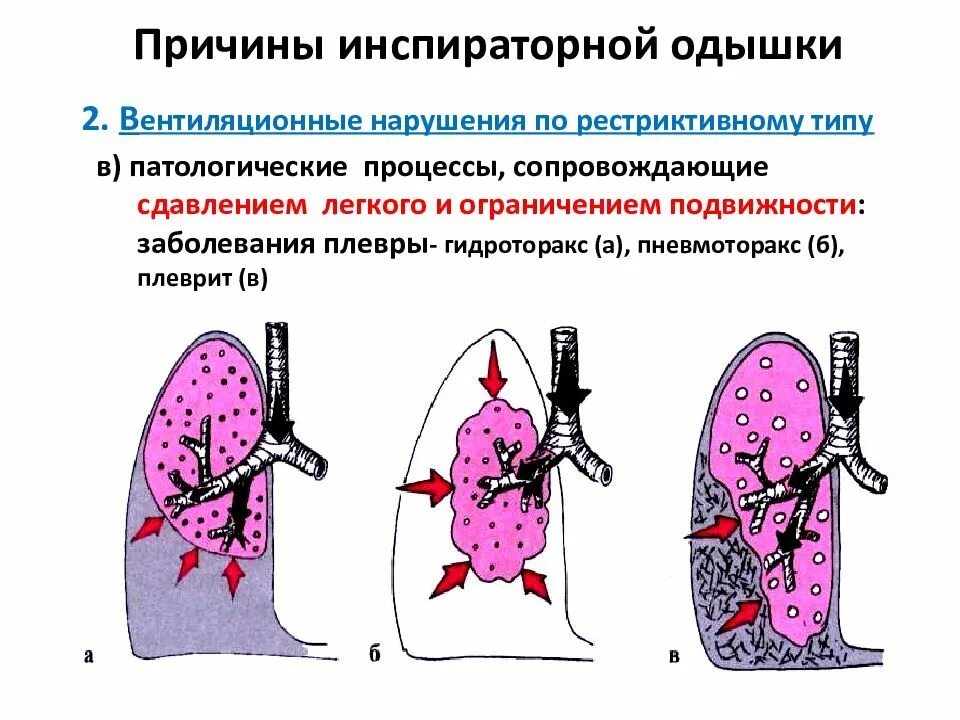 Рестрикция и обструкция дыхательных путей. Рестриктивный Тип нарушения дыхания. Типы одышки экспираторная и инспираторная. Рестрикция бронхов.