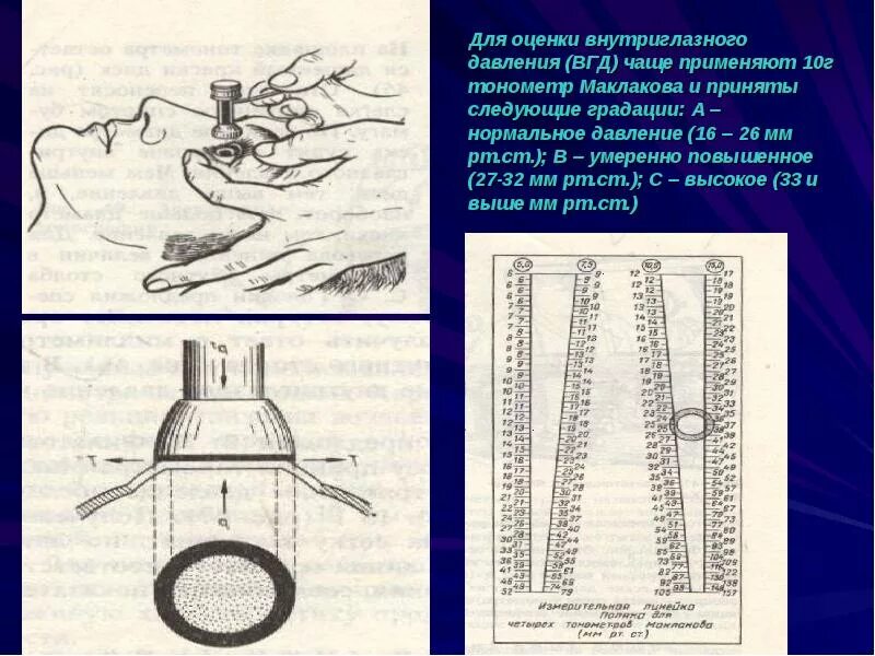 Определение внутриглазного давления. Измерение внутриглазного давления тонометром маклакова. тонометр маклакова используют для измерения давления. тонометр аппланационный маклакова. алгоритм измерения вгд тонометром маклакова.