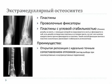 Открытый остеосинтез это