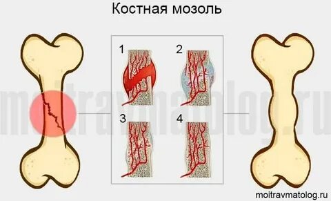 Хрящ после перелома