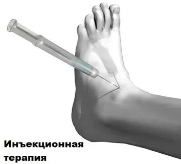 Гиалуроновая кислота в голеностопный