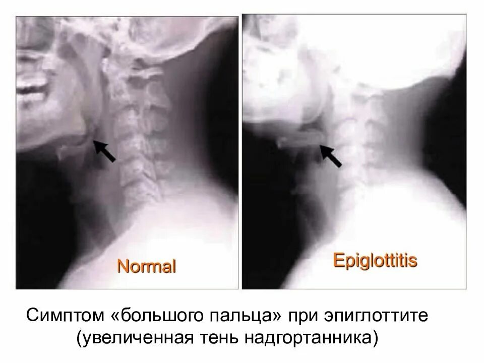 Эпиглоттит симптомы. Эпиглоттит надгортанник. Симптом большого пальца эпиглоттит. Рентгенография при эпиглоттите. Рентген признаки эпиглоттита.
