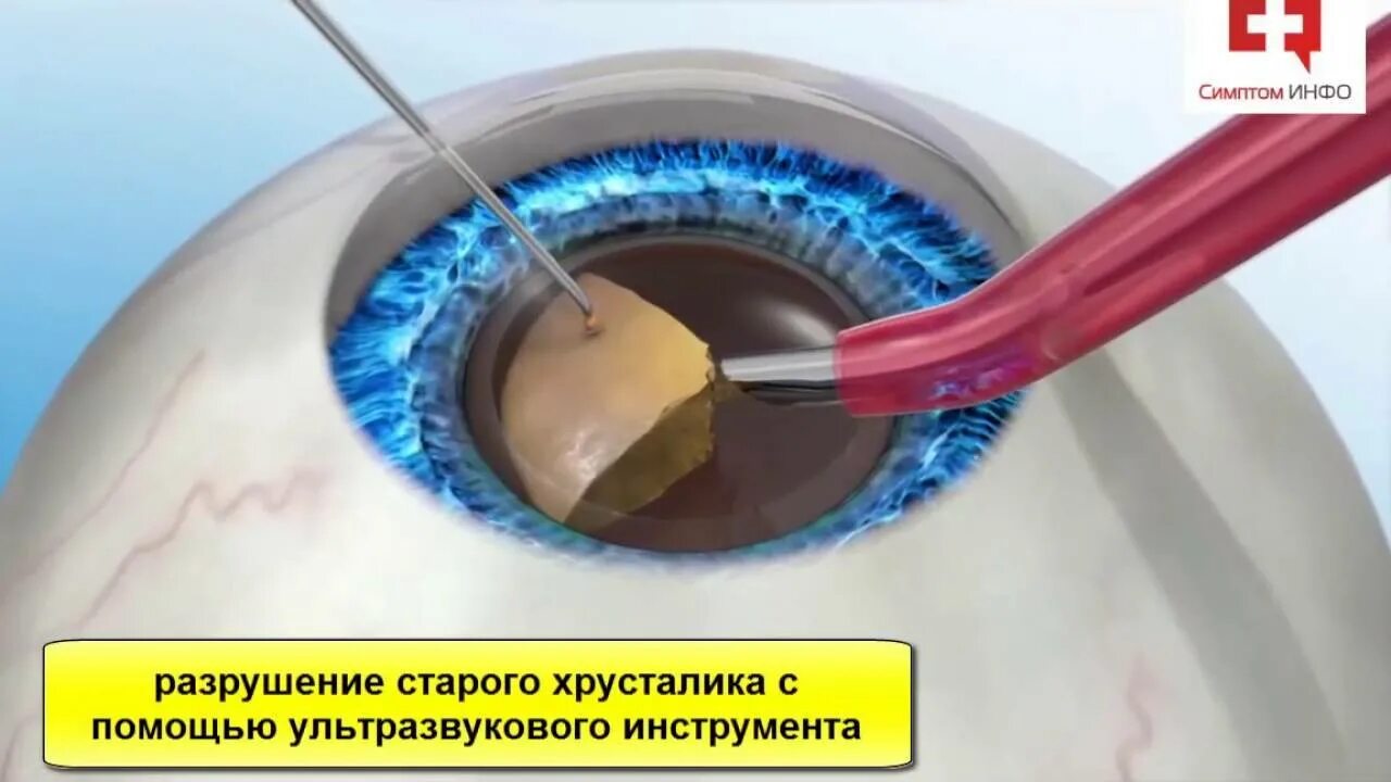 Операция катаракты сколько по времени. Ультразвуковая факоэмульсификация катаракты этапы. Ультразвуковая факоэмульсификация с имплантацией ИОЛ. Факоэмульсификации катаракты глаза. Факоэмульсификация катаракты этапы операции.