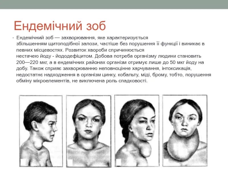 Зоб что это такое как лечить