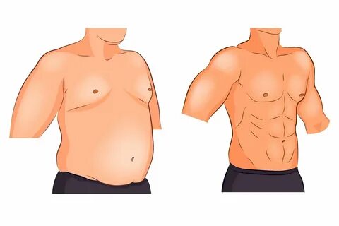 ...gynecomastia #testosterone #testosteronetherapy #testosteroneclinic #tes...