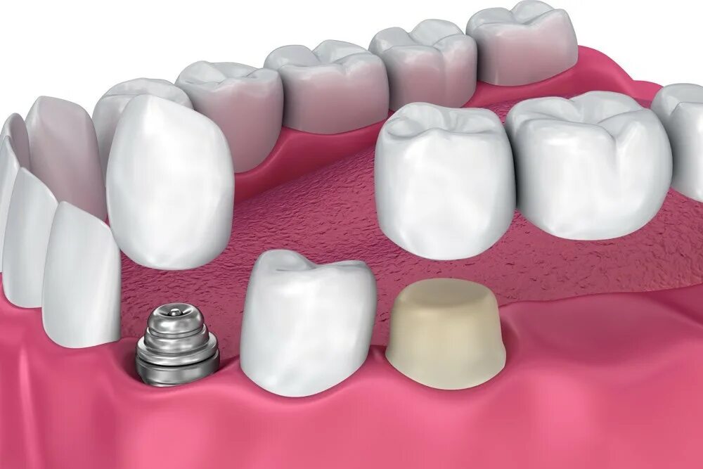 Металлокерамическая коронка. Металло керамическаякорон. Металлокерамическая коронка на зуб. Колодка с металлокерамической. 3 зуба установить