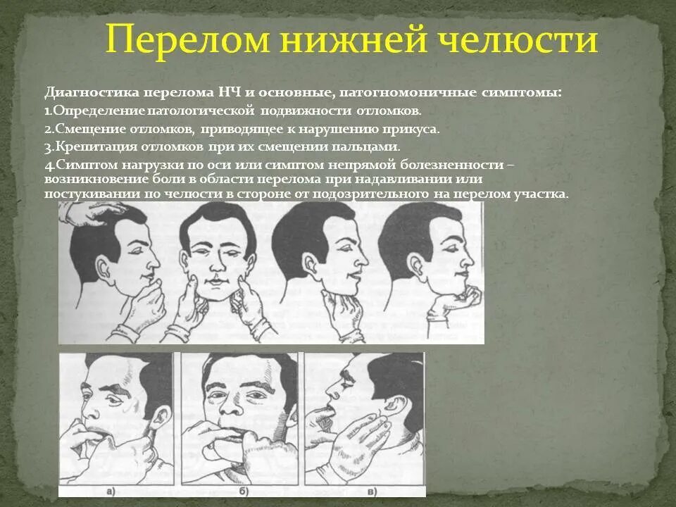 Симптом патологической подвижности. Симптом нагрузки при переломах нижней челюсти. перелом нижней челюсти симптомы. основные симптомы перелома нижней челюсти. симптомы при переломе верхней челюсти.