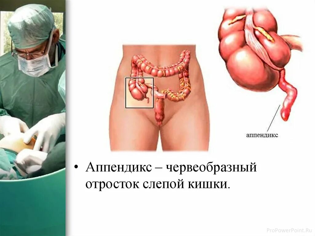 Где аппендицит с какой. Где находится аппендицит.