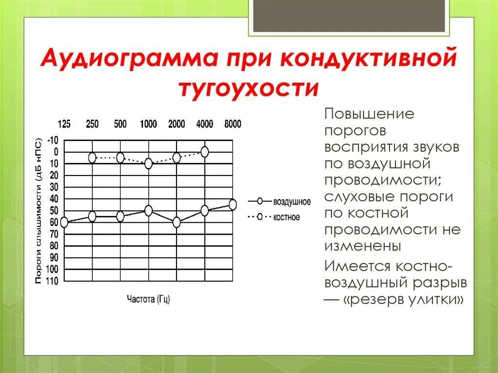 Тест на возраст по частоте звука. Тональная пороговая аудиограмма кондуктивная тугоухость. Кондуктивная тугоухость 2 степени аудиограмма. Аудиограмма 2 степени тугоухости. Тональная пороговая аудиометрия нейросенсорная тугоухость.