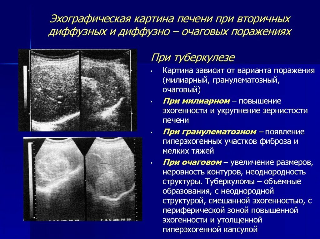 Очаговые изменения печени. Диффузные изменения печени паренхимы печени. Диффузное и очаговое поражение. Очаговый порожения печени.