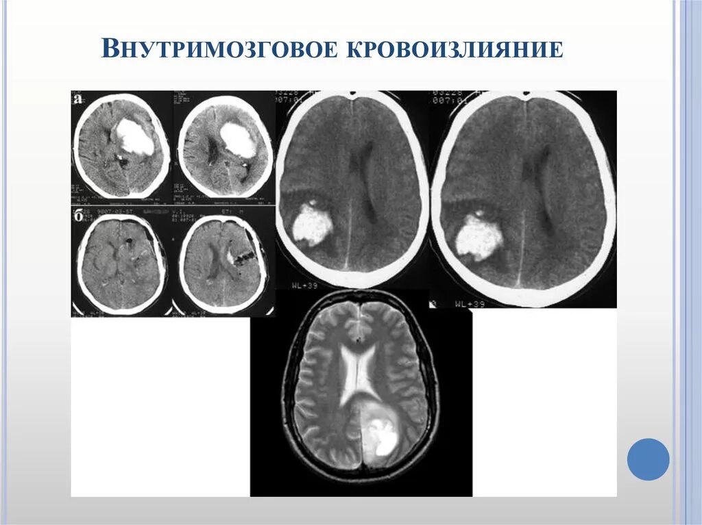 Геморрагический инсульт субарахноидальное кровоизлияние кт. Мрт ГМ внутримозговое кровоизлияние. Внутримозговое (паренхиматозное) кровоизлияние. Внутримозговое кровоизлияние в полушарие.