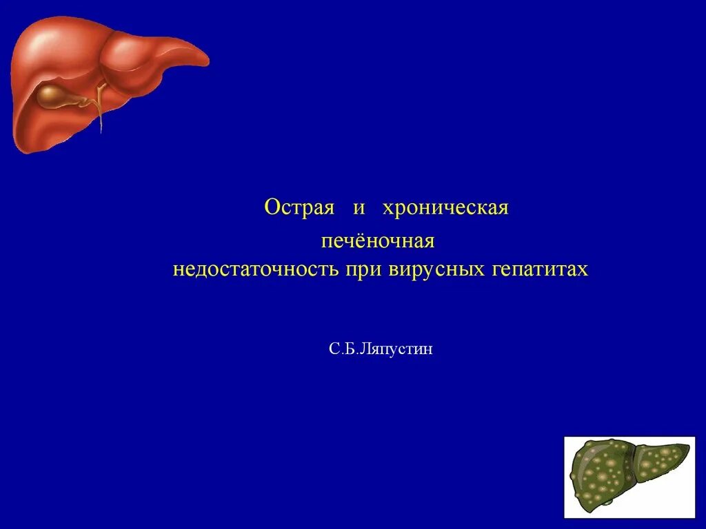 Край печени острый. Острая печеночная недостаточность при вирусных гепатитах. Хроническая печеночная недостаточность. Печеночная недостаточность презентация. Презентация на тему острая печеночная недостаточность.