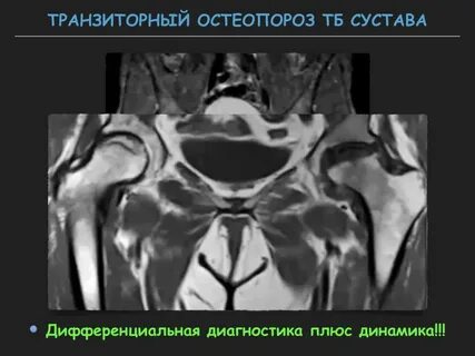 Остеопороз тазобедренного