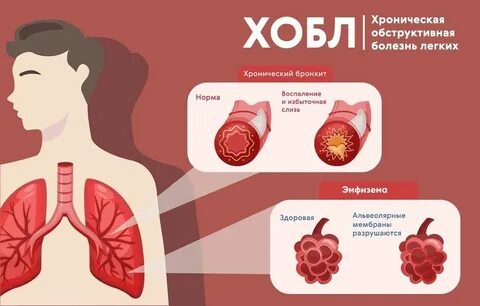 Обструктивное заболевание легких