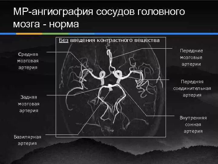 Сосуды головного мозга норма