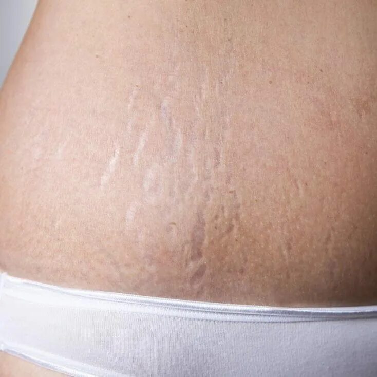 Растяжки stretch marks