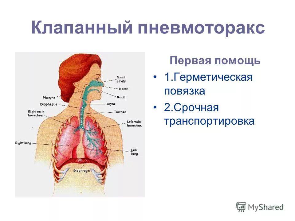 Оказания первой помощи при закрытом пневмотораксе