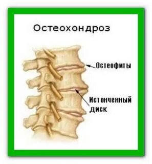 Образование остеофитов