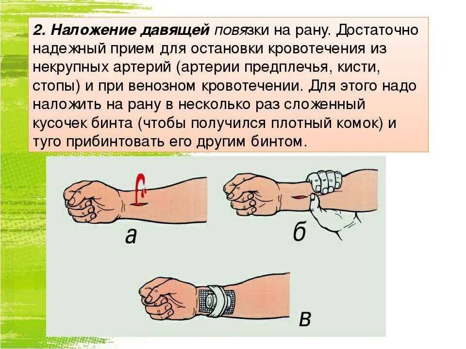 Способы остановки кровотечения наложение давящей повязки. Наложение давящей повязки. нпложенич девяунй повчзки. наложени е давящей позязки. наложение давящей повязки при кровотечении.