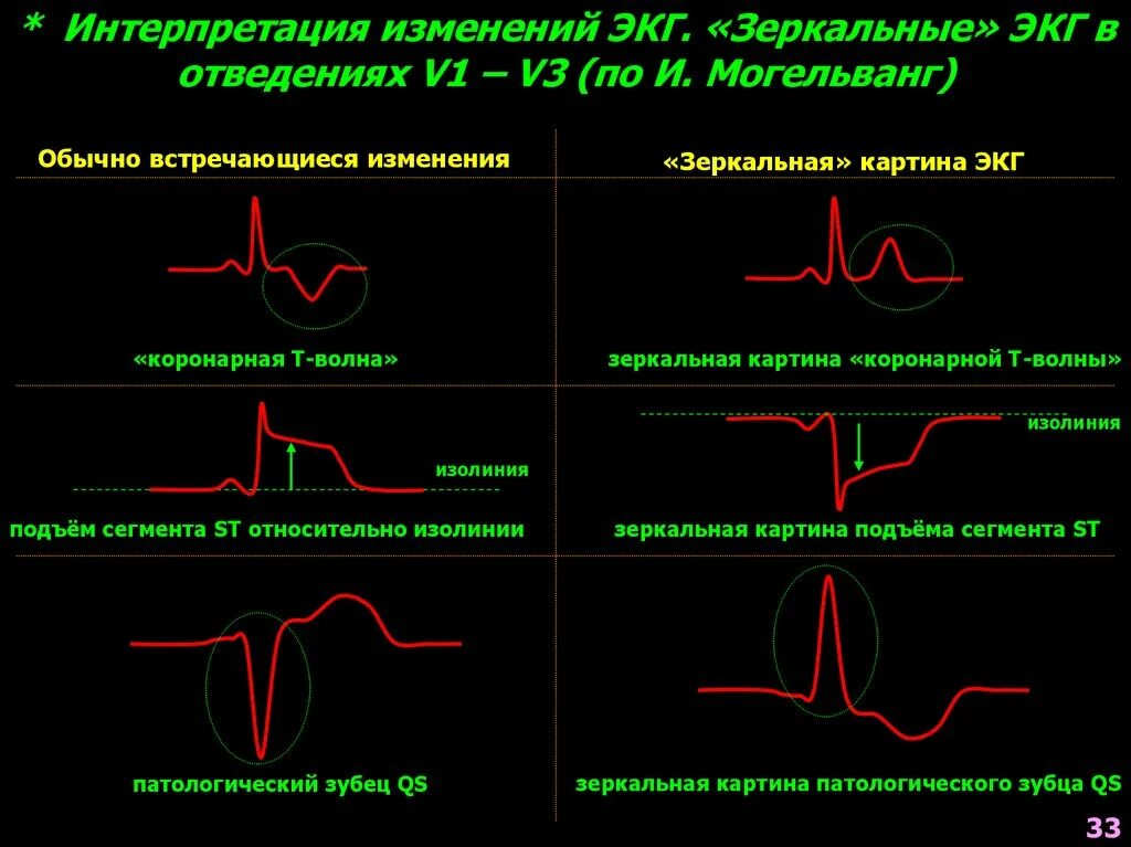 Субэндокардиальная ишемия на ЭКГ. Ишемия на ЭКГ. Субэпикардиальная ишемия на ЭКГ. Отведение v2 на ЭКГ норма. Отведение v1 на экг