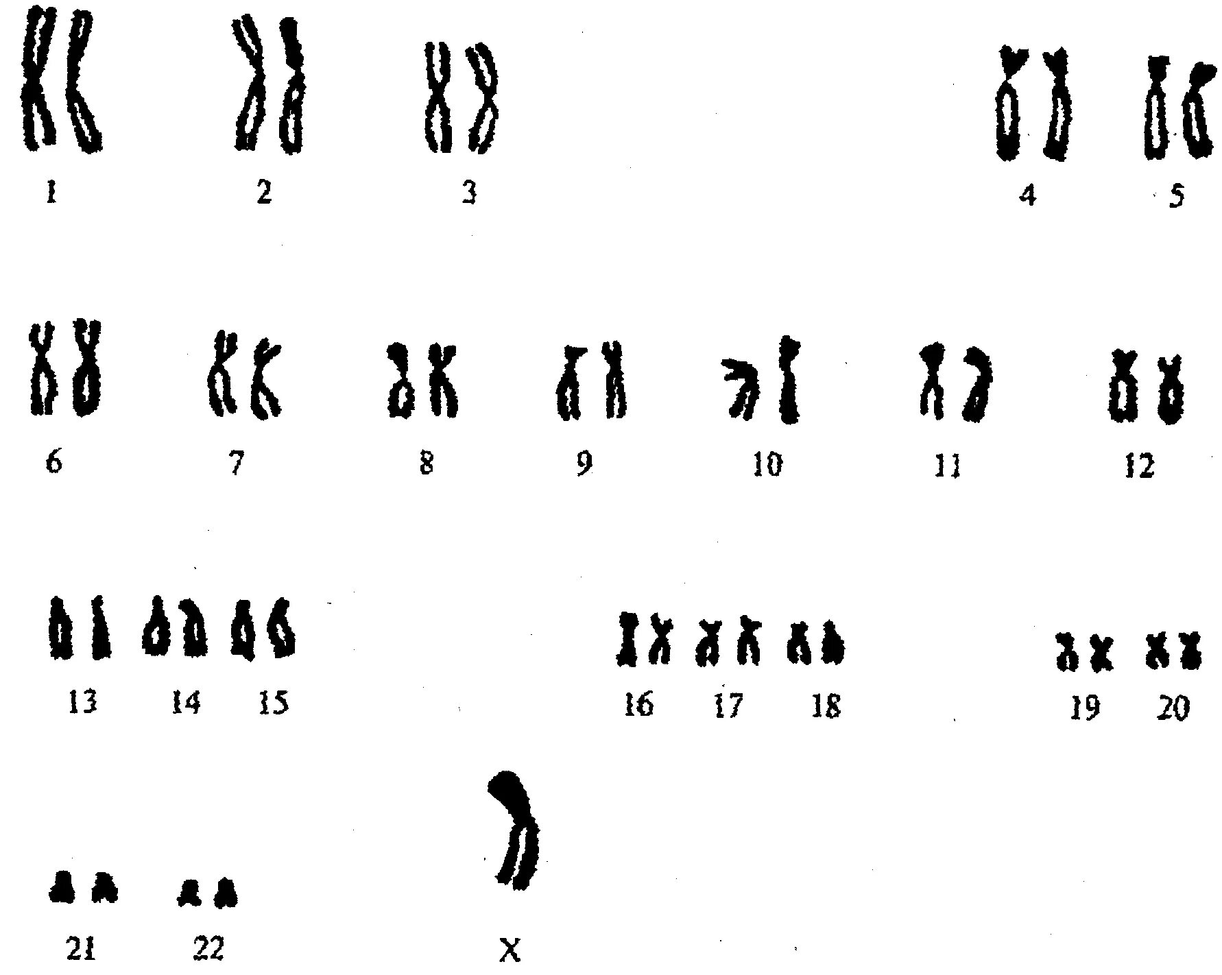 Трипло х. Кариограмма хромосом. Кариотип человека с синдромом Шерешевского-Тернера. Синдром Шерешевского Тернера хромосомы. Синдром Шерешевского Тернера кариотип.