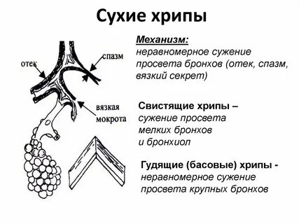 Сухой хрип